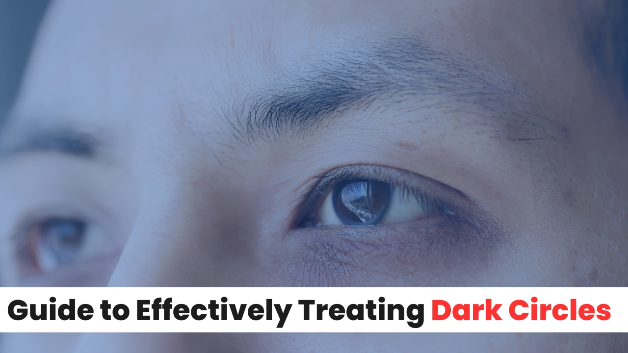 Your Guide to Effectively Treating Dark Circles
