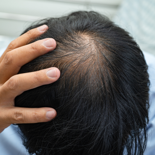 Hair Transplant in Lahore
